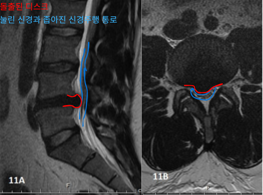 허리 디스크 MRI 사진으로, 디스크가 튀어나와 신경을 누르고 신경이 지나가는 통로가 좁아진 모습을 보여줍니다