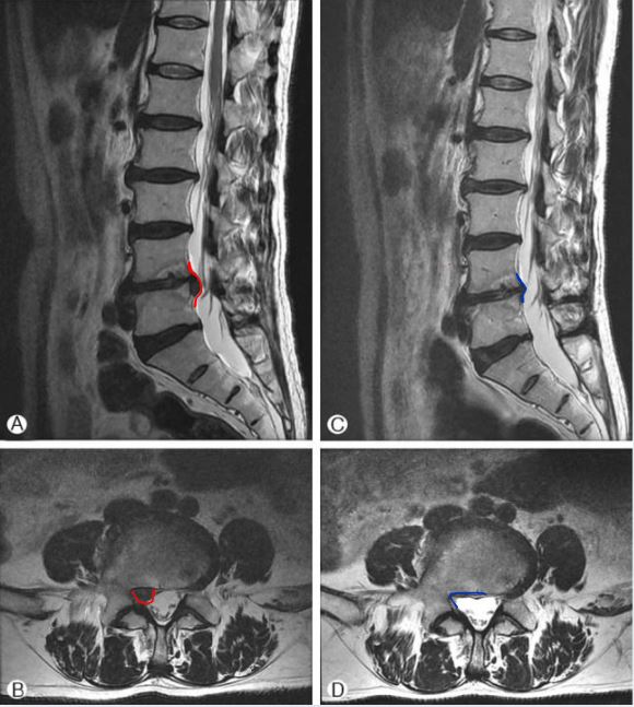 허리 디스크 MRI 사진으로, 초기 디스크 돌출과 시간이 지나 흡수되어 줄어든 모습을 비교한 이미지